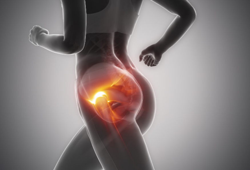 Entendendo a Síndrome do Impacto Femoroacetabular (SIFA)